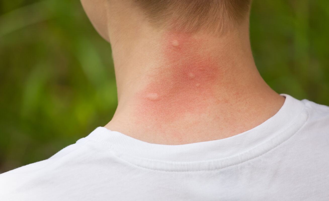 mosquito bites on the neck. Reddened, inflamed skin.