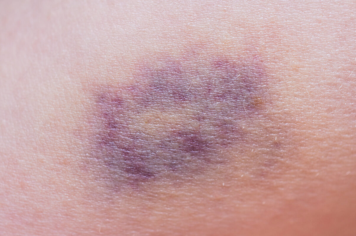 Macro shot of purple bruise on skin