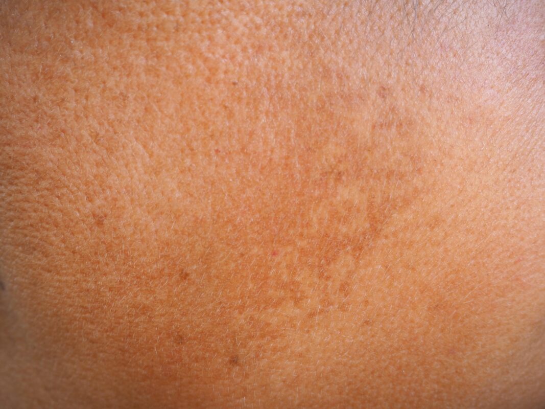 skin with dark spots from sun exposure